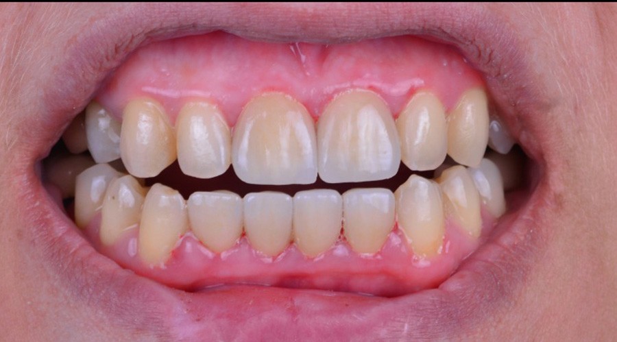 قبل تركيبات-اسنان